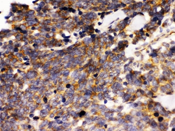 IHC testing of FFPE human lung cancer tissue with PTPRF antibody. HIER: Boil the paraffin sections in pH 6, 10mM citra
