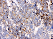 IHC testing of FFPE human lung cancer tissue with GRP78 antibody. HIER: Boil the paraffin sections in pH 6, 10mM citrate buffer for 20 minutes and allow to cool prior to staining.