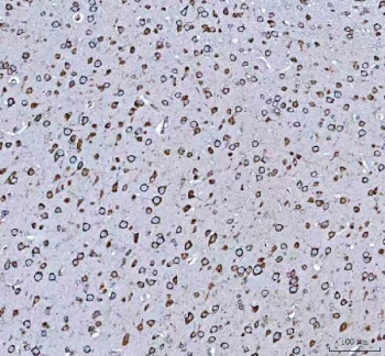 IHC testing of FFPE human lung cancer tissue with GRP78 antibody. HIER: Boil the paraffin sections in pH 6, 10mM citrate buffer for 20 minutes and allow to cool prior to staining.