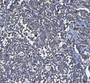 IHC staining of FFPE human lung adenocarcinoma tissue with GRP78 antibody. HIER: boil tissue sections in pH8 EDTA for 20 min and allow to cool before testing.
