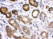 IHC testing of FFPE human breast cancer tissue with HSC70 antibody. HIER: Boil the paraffin sections in pH 6, 10mM citrate buffer for 20 minutes and allow to cool prior to staining.