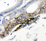 IHC testing of FFPE human breast cancer with SLC2A1 antibody. HIER: Boil the paraffin sections in pH 8 EDTA for 20 minutes and allow to cool prior to staining.
