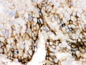 IHC testing of FFPE human liver cancer with SLC2A2 antibody. HIER: Boil the paraffin sections in pH 6, 10mM citrate buffer for 20 minutes and allow to cool prior to staining.
