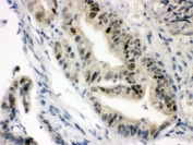IHC testing of FFPE human intestine cancer with SLC22A2 antibody. HIER: Boil the paraffin sections in pH 6, 10mM citrate buffer for 20 minutes and allow to cool prior to staining.
