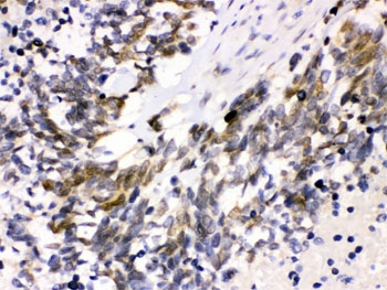 IHC testing of FFPE human lung cancer tissue with Cdk4 antibody. HIER: Boil the paraffin sections in pH 6, 10mM citrate buffer for 20 minutes and allow to cool prior to staining.