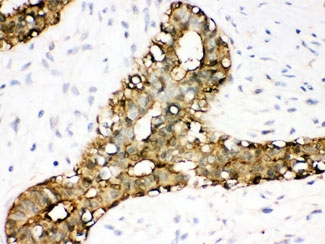 IHC testing of FFPE human breast cancer with Annexin A3 antibody. HIER: Boil the paraffin sections in pH 6, 10mM citrate buffer for 20 minutes and allow to cool prior to staining.