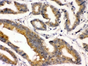 IHC testing of FFPE human intestinal cancer tissue with BMP2 antibody. HIER: Boil the paraffin sections in pH 6, 10mM citrate buffer for 20 minutes and allow to cool prior to staining.