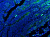 Immunofluorescent staining of FFPE human colon cancer tissue with E-Cadherin antibody (green) and DAPI nuclear stain (blue). HIER: steam section in pH6 citrate buffer for 20 min.