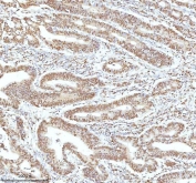 IHC staining of FFPE human colon adenocarcinoma tissue with Ku70 antibody. HIER: boil tissue sections in pH8 EDTA for 20 min and allow to cool before testing.