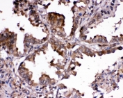 IHC staining of FFPE human lung cancer tissue with Ribonuclease Inhibitor antibody. HIER: boil tissue sections in pH6 citrate buffer for 20 min and allow to cool before testing.