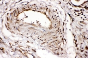 IHC staining of FFPE human intestinal cancer tissue with Ribonuclease Inhibitor antibody. HIER: boil tissue sections in pH6 citrate buffer for 20 min and allow to cool before testing.