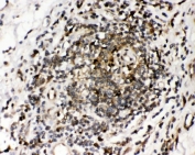 IHC staining of FFPE human intestinal cancer tissue with Ribonuclease Inhibitor antibody. HIER: boil tissue sections in pH6 citrate buffer for 20 min and allow to cool before testing.