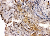 IHC staining of FFPE human lung cancer tissue with Ribonuclease Inhibitor antibody. HIER: boil tissue sections in pH6 citrate buffer for 20 min and allow to cool before testing.