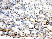 IHC testing of FFPE human glioma tissue with Versican antibody. HIER: Boil the paraffin sections in pH 6, 10mM citrate buffer for 20 minutes and allow to cool prior to staining.