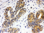IHC testing of FFPE human breast cancer with Integrin alpha 4 antibody. HIER: Boil the paraffin sections in pH 6, 10mM citrate buffer for 20 minutes and allow to cool prior to staining.