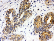 IHC testing of FFPE human breast cancer with Integrin alpha 4 antibody. HIER: Boil the paraffin sections in pH 6, 10mM citrate buffer for 20 minutes and allow to cool prior to staining.