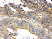 IHC testing of FFPE human intestinal cancer tissue with OSM antibody. HIER: Boil the paraffin sections in pH 6, 10mM citrate buffer for 20 minutes and allow to cool prior to staining.