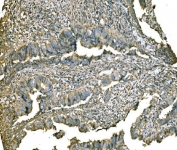 IHC staining of FFPE human colorectal adenocarcinoma tissue with PKM2 antibody. HIER: boil tissue sections in pH8 EDTA for 20 min and allow to cool before testing.