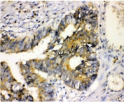 IHC staining of FFPE human intestinal cancer with GRP94 antibody. HIER: boil tissue sections in pH8 EDTA for 20 min and allow to cool before testing.