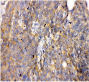IHC staining of FFPE human lung cancer with GRP94 antibody. HIER: boil tissue sections in pH8 EDTA for 20 min and allow to cool before testing.