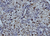 IHC staining of FFPE human liver cancer with MMP9 antibody. HIER: boil tissue sections in pH8 EDTA for 20 min and allow to cool before testing.