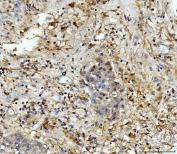 IHC staining of FFPE human liver cancer with MMP9 antibody. HIER: boil tissue sections in pH8 EDTA for 20 min and allow to cool before testing.