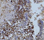 IHC staining of FFPE human colon adenocarcinoma with MMP9 antibody. HIER: boil tissue sections in pH8 EDTA for 20 min and allow to cool before testing.