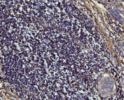 IHC staining of lymph node in FFPE human gastric adenocarcinoma-rectal cancer with MMP9 antibody. HIER: boil tissue sections in pH8 EDTA for 20 min and allow to cool before testing.