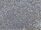 IHC staining of FFPE human lymphadenoma tissue with MMP9 antibody. HIER: boil tissue sections in pH8 EDTA for 20 min and allow to cool before testing.