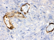 IHC testing of FFPE human lung cancer tissue with IDO1 antibody. HIER: Boil the paraffin sections in pH 6, 10mM citrate buffer for 20 minutes and allow to cool prior to staining.