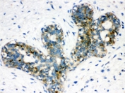 IHC testing of FFPE human breast cancer tissue with ARSA antibody. HIER: Boil the paraffin sections in pH 6, 10mM citrate buffer for 20 minutes and allow to cool prior to staining.
