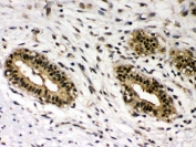 IHC testing of human breast cancer tissue with c-Rel antibody. HIER: Boil the paraffin sections in pH 6, 10mM citrate buffer for 20 minutes and allow to cool prior to staining.