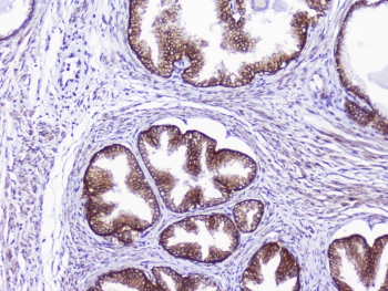 IHC testing of FFPE human prostate cancer tissue with CD46 antibody. HIER: Boil the paraffin sections in pH 6, 10mM citrate buffer for 20 minutes and allow to cool prior to staining.