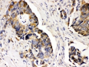 IHC testing of FFPE human intestinal cancer wtih PDGFR alpha antibody. HIER: Boil the paraffin sections in pH 6, 10mM citrate buffer for 20 minutes and allow to cool prior to staining.