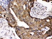 IHC testing of FFPE human breast cancer with POR antibody. HIER: Boil the paraffin sections in pH 6, 10mM citrate buffer for 20 minutes and allow to cool prior to staining.