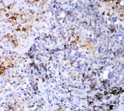 IHC staining of FFPE human lung cancer tissue with CD36 antibody. HIER: Boil the paraffin sections in pH 6, 10mM citrate buffer for 20 minutes and allow to cool prior to staining.