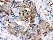 IHC testing of FFPE human breast cancer tissue with Stathmin 1 antibody. HIER: Boil the paraffin sections in pH 6, 10mM citrate buffer for 20 minutes and allow to cool prior to staining.