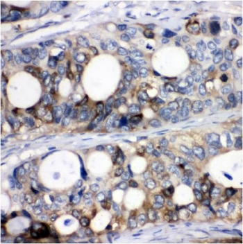 IHC testing of FFPE human intestinal cancer tissue with Stathmin 1 antibody. HIER: Boil the paraffin sections in pH 8 EDTA for 20 minutes and allow to cool prior to staining.