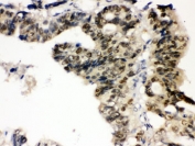 IHC testing of FFPE human intestinal cancer wtih PTPN2 antibody. HIER: Boil the paraffin sections in pH 6, 10mM citrate buffer for 20 minutes and allow to cool prior to staining.