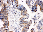 IHC testing of FFPE human intestinal cancer tissue with IGFBP3 antibody. HIER: Boil the paraffin sections in pH 6, 10mM citrate buffer for 20 minutes and allow to cool prior to staining.