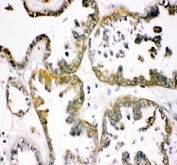 IHC staining of FFPE human ovarian cancer tissue with TCP1 alpha antibody. HIER: boil tissue sections in pH8 EDTA for 20 min and allow to cool before testing.