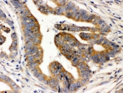 IHC testing of FFPE human intestinal cancer tissue with RAB5 antibody. HIER: Boil the paraffin sections in pH 6, 10mM citrate buffer for 20 minutes and allow to cool prior to staining.