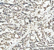 IHC staining of FFPE human colorectal adenocarcinoma tissue with LMNB1 antibody. HIER: boil tissue sections in pH8 EDTA for 20 min and allow to cool before testing.