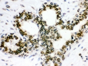 IHC testing of FFPE human breast cancer tissue with LMNB1 antibody. HIER: Boil the paraffin sections in pH 6, 10mM citrate buffer for 20 minutes and allow to cool prior to staining.