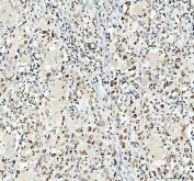 IHC staining of FFPE human urothelial carcinoma tissue with LMNB1 antibody. HIER: boil tissue sections in pH8 EDTA for 20 min and allow to cool before testing.