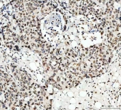 IHC staining of FFPE human breast cancer tissue with LMNB1 antibody. HIER: boil tissue sections in pH8 EDTA for 20 min and allow to cool before testing.