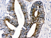 IHC testing of FFPE human intestinal cancer with MAOA antibody. HIER: Boil the paraffin sections in pH 6, 10mM citrate buffer for 20 minutes and allow to cool prior to staining.