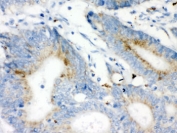 IHC testing of FFPE human intestinal cancer tissue with VDAC antibody. HIER: Boil the paraffin sections in pH 6, 10mM citrate buffer for 20 minutes and allow to cool prior to staining.