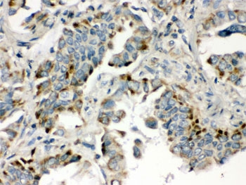 IHC testing of FFPE human lung cancer tissue with BMP5 antibody. HIER: Boil the paraffin sections in pH 6, 10mM citrate buffer for 20 minutes and allow to cool prior to staining.
