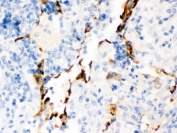 IHC testing of FFPE human lung cancer tissue with Kv1.4 antibody. HIER: Boil the paraffin sections in pH 6, 10mM citrate buffer for 20 minutes and allow to cool prior to staining.